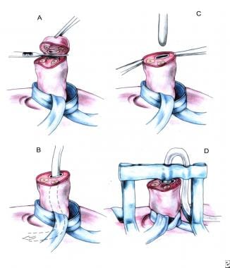 Umbilical vein catheterization. (A) Umbilical tape