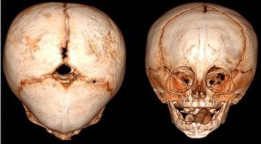 3D reconstruction of child with metopic craniosyno