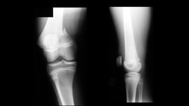 Growth plate (physeal) fractures. Displaced Salter
