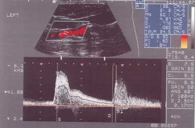 Internal carotid artery as seen on spectral analys