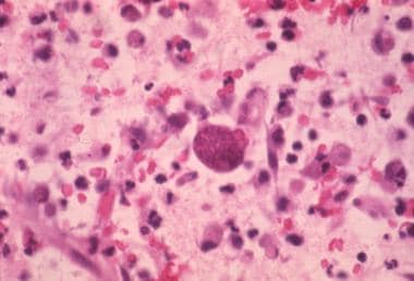 toxoplasmosis brain pathology