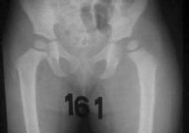 Second radiograph in series of septic left hip. Th