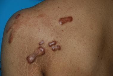 Papular lesions: Keloids developed from back acne.