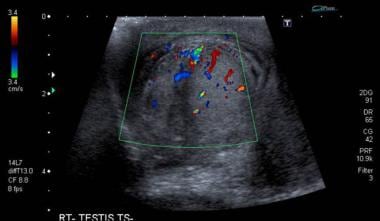 Transverse view of the testis and epididymis with 