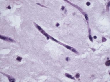 Microscopic image shows so-called myxoma cell. Myx