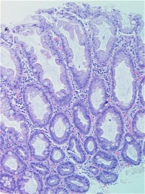 tubulovillous adenoma with dysplasia