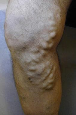 Which Varicose Vein Treatment Is Right for Me?: Vascular