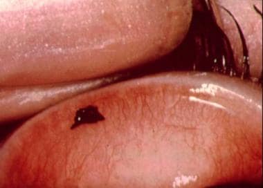 Conjunctival foreign body on upper lid. 