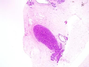 intraductalis papilloma medscape)