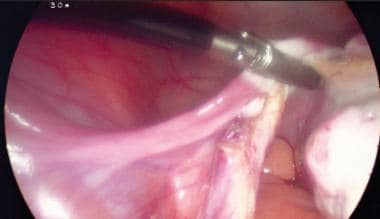 Salpingo oophorectomy laparoscopic photo. Clamping