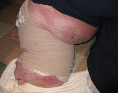 广泛性手术的慢性下肢后遗症