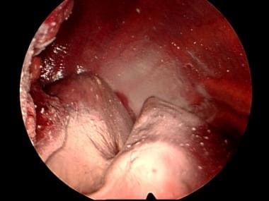 Talc pleurodesis on lung and parietal pleura. 