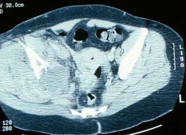 Computed tomography scan demonstrates a destructiv