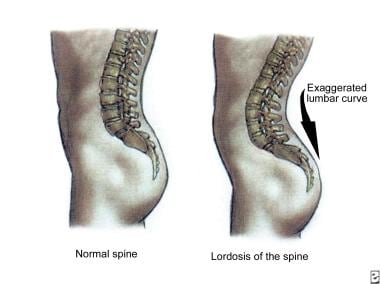 Lumbar lordosis of pregnancy. 
