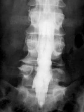 Postoperative anteroposterior (AP) myelogram revea