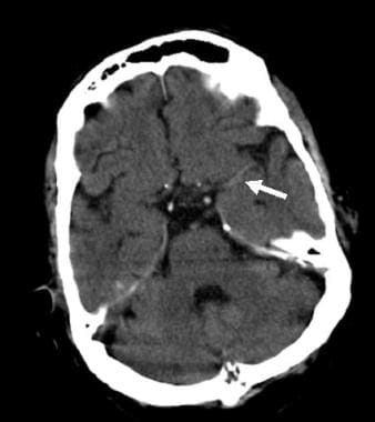 Noncontrast CT scan in an 80-year-old female who p