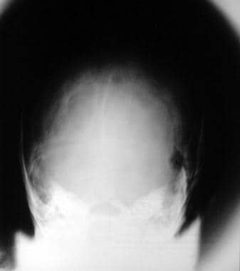 Plain radiograph in a patient with NF1 shows a lef