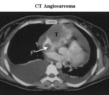 Contrast-enhanced CT scan of a patient with an ang