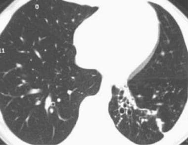 This HRCT scan in a 13-year-old female shows left 