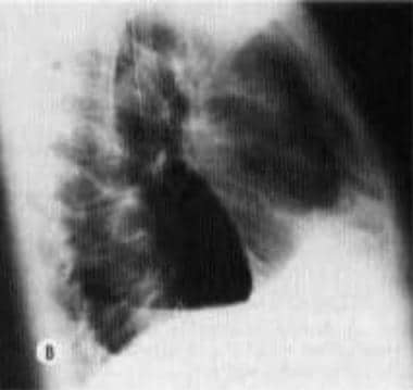 Lateral chest image obtained in the same patient a