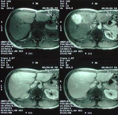 Liver metastases. Mimics. Dynamic MRIs in a 36-yea