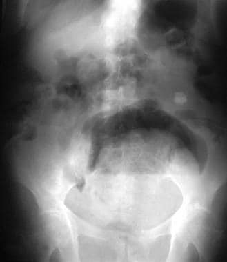 Erect abdominal radiograph demonstrating a giant s