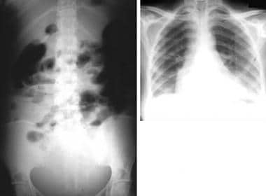 Plain erect abdominal radiograph shows nonobstruct