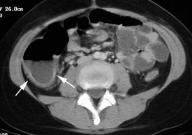 Typhlitis. CT of this 10-year-old patient with leu