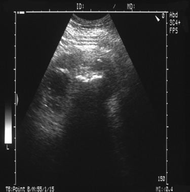 A 57-year-old woman with diabetes presented with a