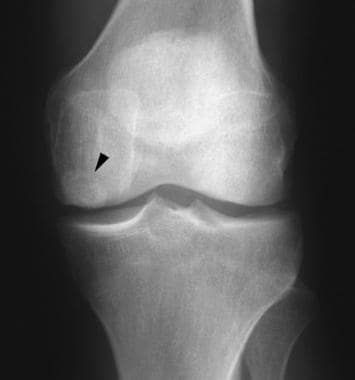 Anteroposterior radiograph of the knee shows that 