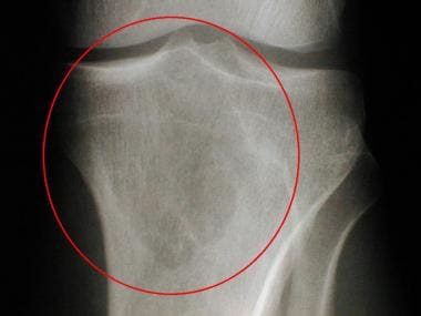 Radiograph of the proximal tibia obtained 5 years 