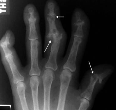 Anteroposterior radiograph of the hand in a patien