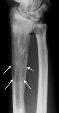 Anteroposterior radiograph of the distal forearm d