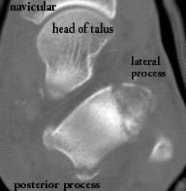 Fractures of the lateral and posterior processes o