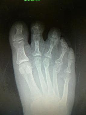 Radiograph shows malunited 4th metatarsal neck fra