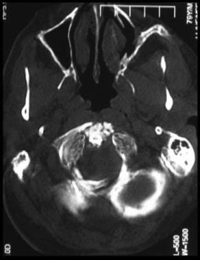 Axial unenhanced computed tomography image through