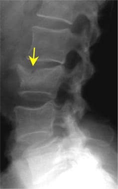 Lumbar spine trauma. Lateral view of the lumbar sp