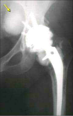 Image of the femoral component from a patient who 