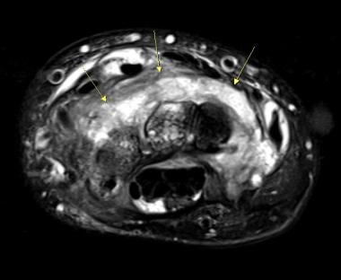 Axial T2-weighted fat-suppresed MR image at the le