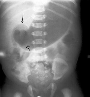 Anteroposterior radiograph demonstrates an enlarge