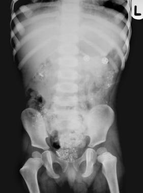 Lead poisoning. Pica. Plain abdominal radiograph i