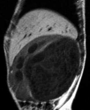 Multilocular cystic nephroma. Sagittal MRI shows a