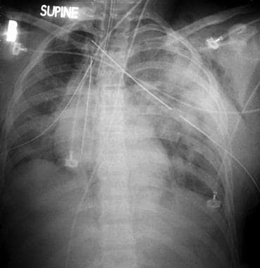 This chest radiograph demonstrates bilateral pulmo