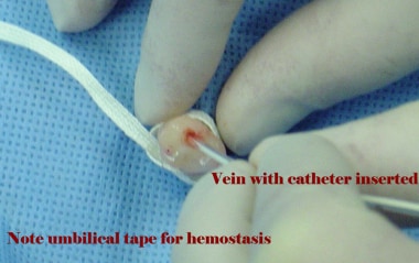 Umbilical vein catheterization. Insertion of umbil