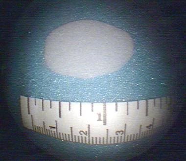 Photograph of a porous polyethylene implant trimme