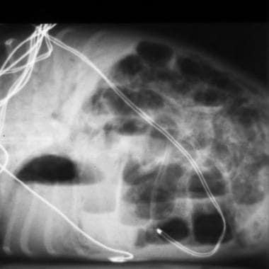 Radiograph depicts necrotizing enterocolitis in a 