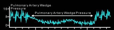 Pulmonary artery wedge pressure (PAWP) reflects le