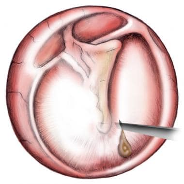 tympanic membrane landmarks