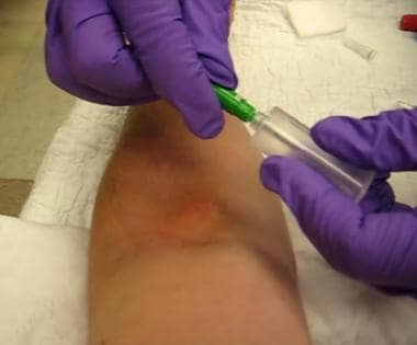 Phlebotomy. Assembly of Vacutainer(R) device.