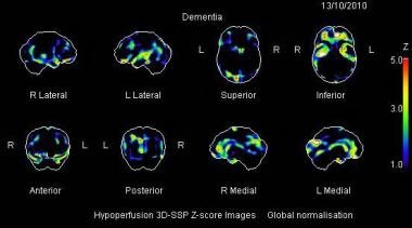 spect brain